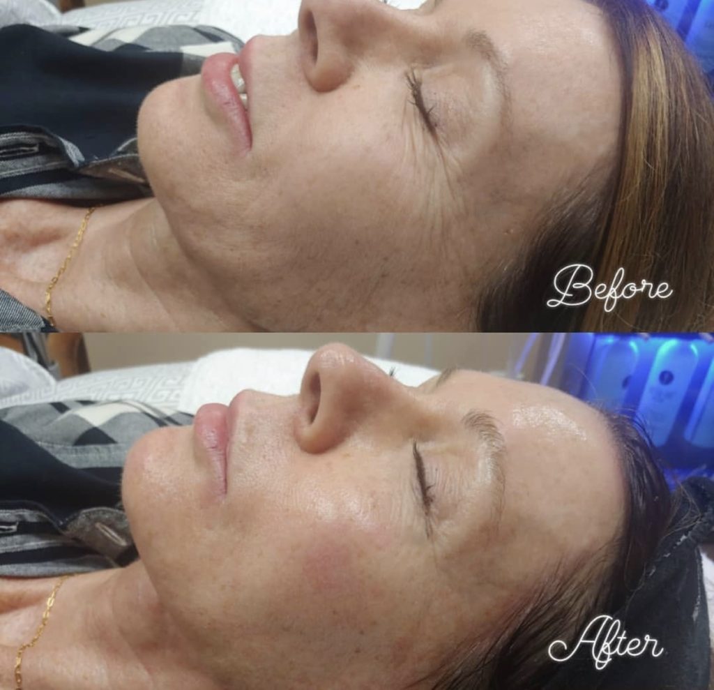 Bild: vor und nach einer Behandlung mit Hydrafacial